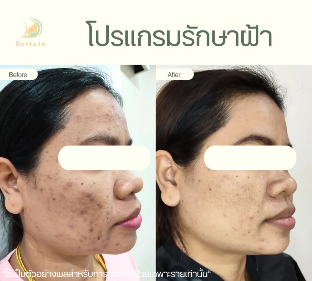 รีวิวรักษาฝ้า 1 - เดอร์เลนคลินิก