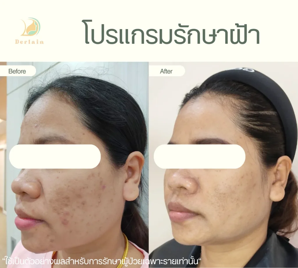 รีวิวรักษาฝ้า 2 - เดอร์เลนคลินิก