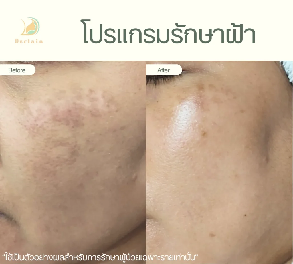 รีวิวรักษาฝ้า 4 - เดอร์เลนคลินิก