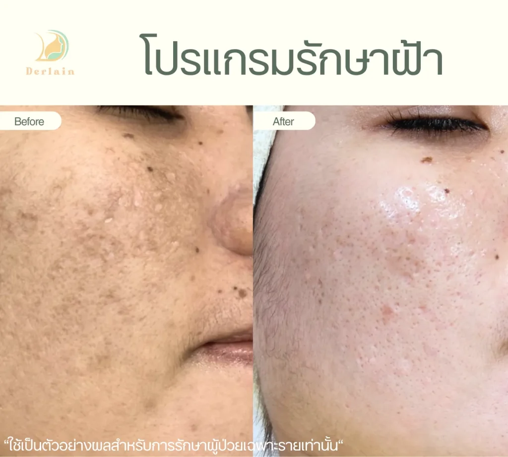 รีวิวรักษาฝ้า 5 - เดอร์เลนคลินิก
