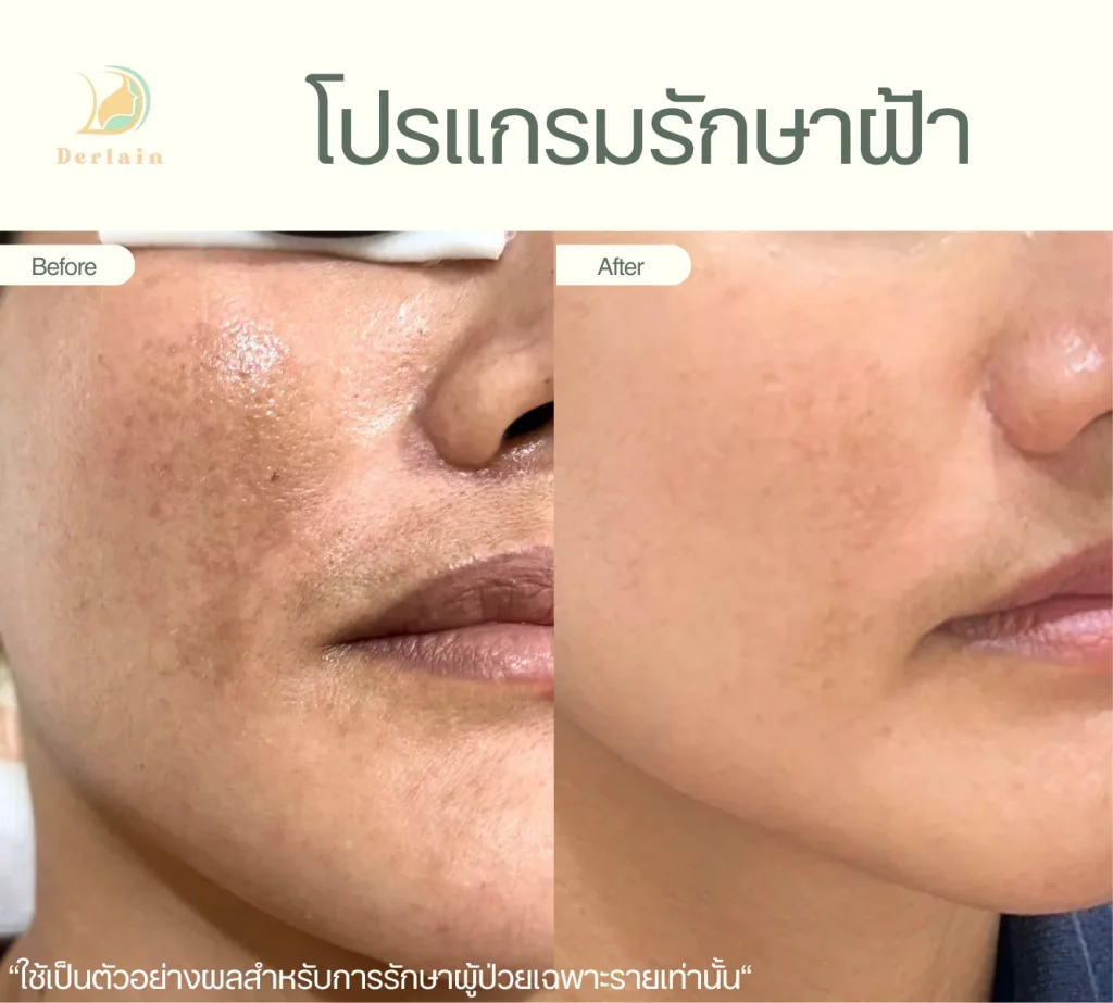 รีวิวรักษาฝ้า 6 - เดอร์เลนคลินิก