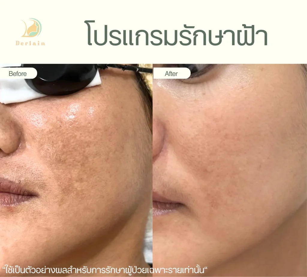 รีวิวรักษาฝ้า 7 - เดอร์เลนคลินิก