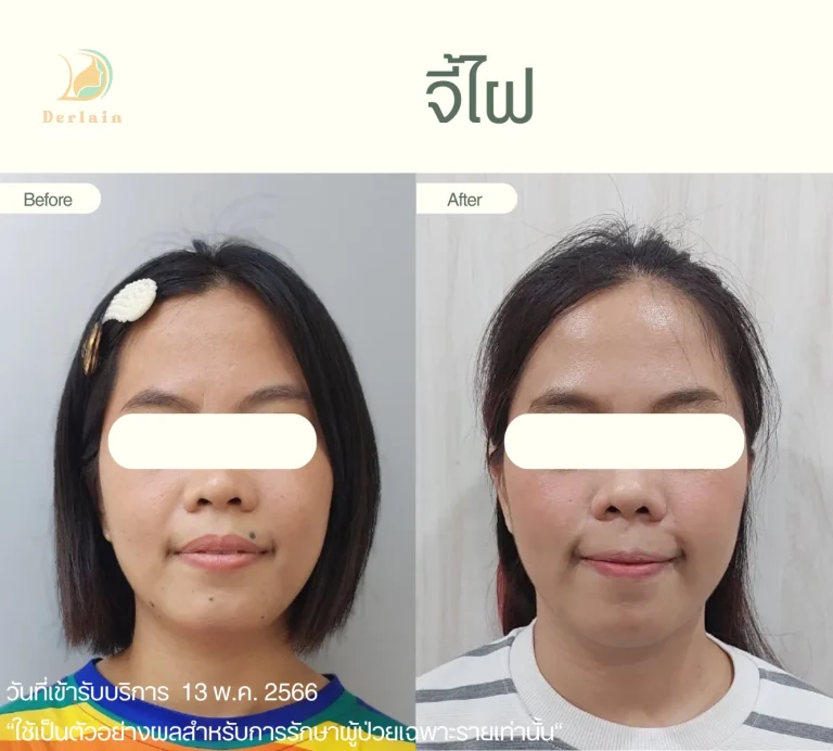 รีวิวจี้ไฝขี้แมลงวัน 1 - เดอร์เลนคลินิก