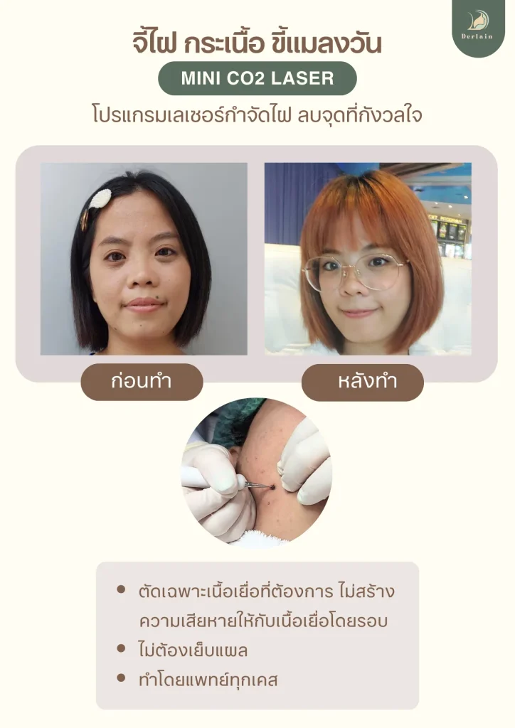 รายละเอียดบริการจี้ไฝ - เดอร์เลนคลินิก