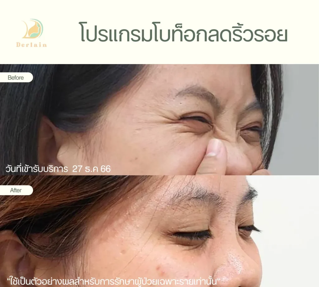 รีวิวโบท็อกริ้วรอย 1 - เดอร์เลนคลินิก