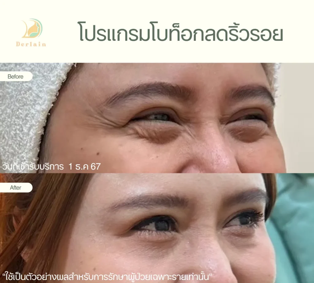 รีวิวโบท็อกริ้วรอย 4 - เดอร์เลนคลินิก