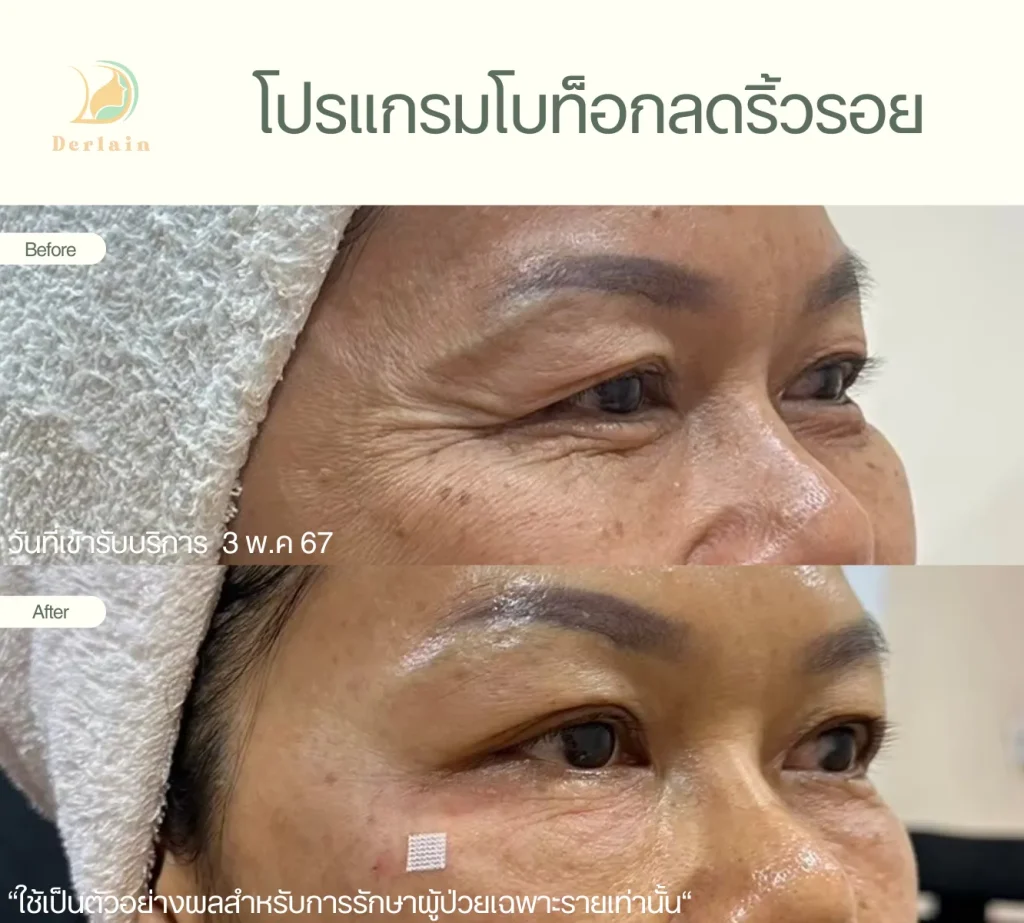 รีวิวโบท็อกริ้วรอย 6 - เดอร์เลนคลินิก