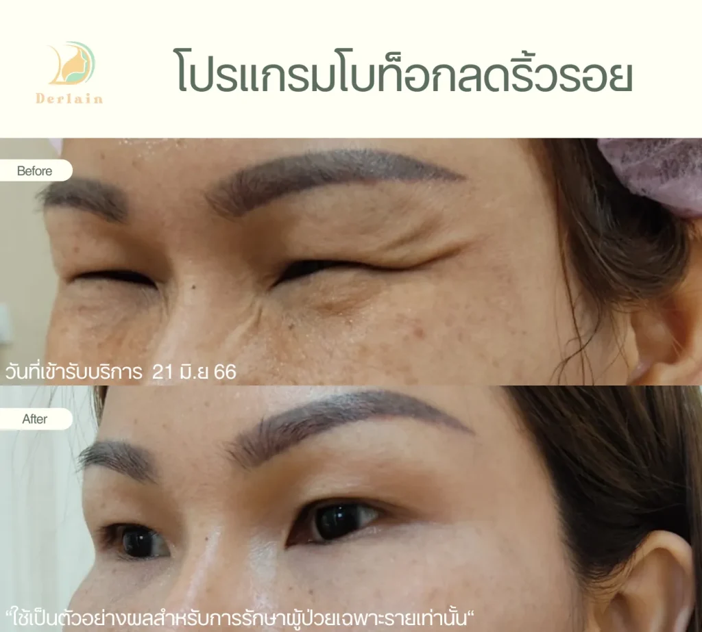 รีวิวโบท็อกริ้วรอย 7 - เดอร์เลนคลินิก