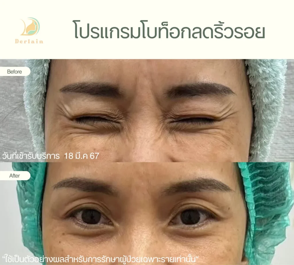 รีวิวโบท็อกริ้วรอย 8 - เดอร์เลนคลินิก
