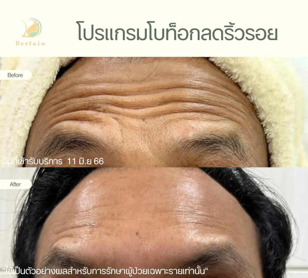 รีวิวโบท็อกริ้วรอย 9 - เดอร์เลนคลินิก