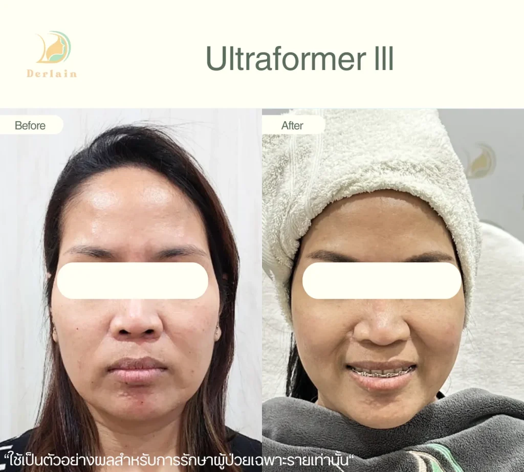 รีวิว Ultraformer lll ยกกระชับผิว 1 - เดอร์เลนคลินิก