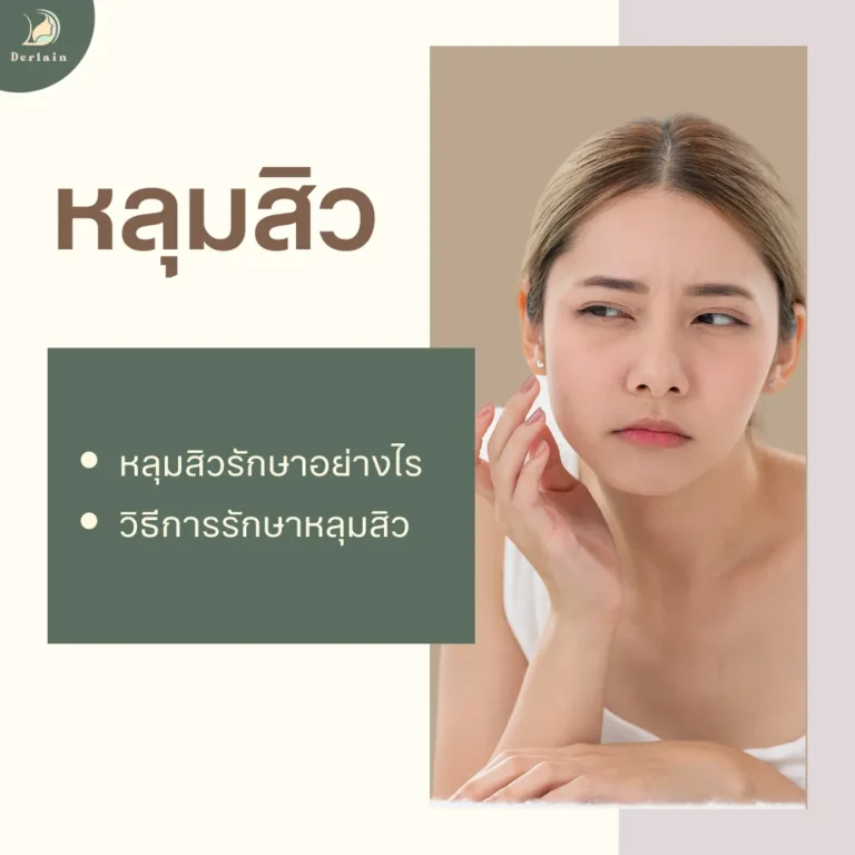 หลุมสิว - เดอร์เลนคลินิก