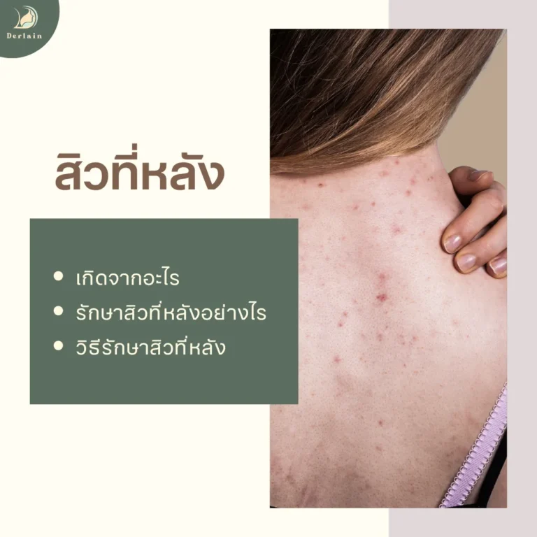 สิวที่หลัง - เดอร์เลนคลินิก