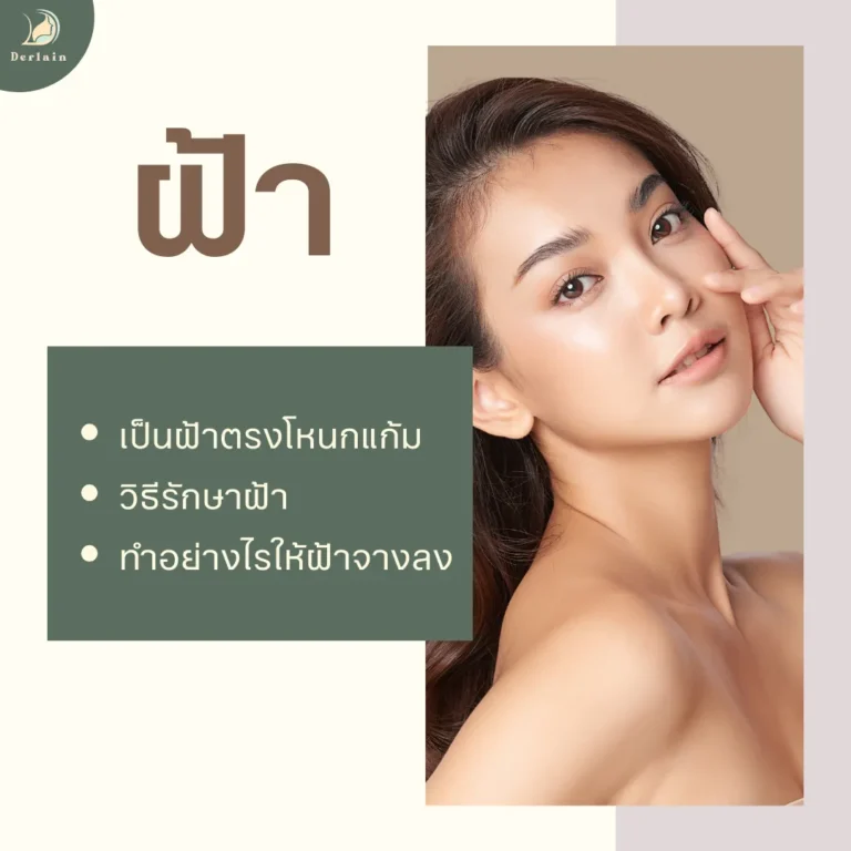 ฝ้ากระ ฝ้าแดด - เดอร์เลนคลินิก