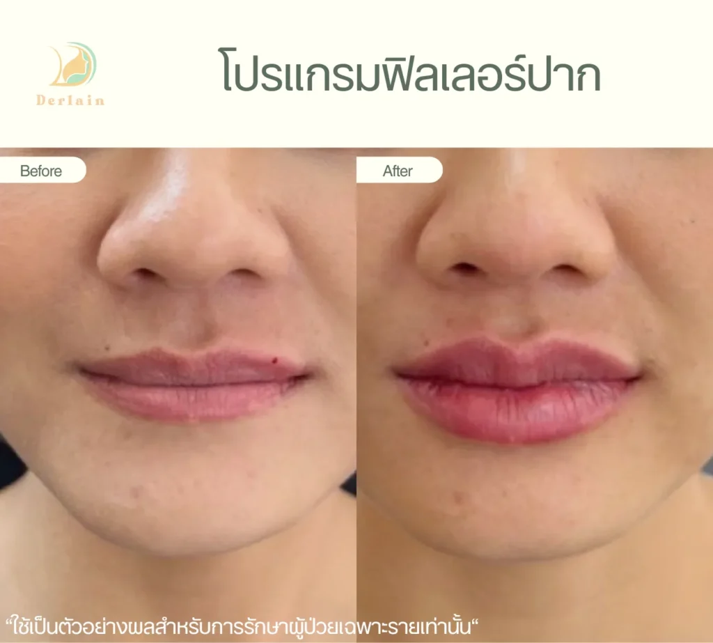 รีวิวฟิลเลอร์ปาก 4 - เดอร์เลนคลินิก