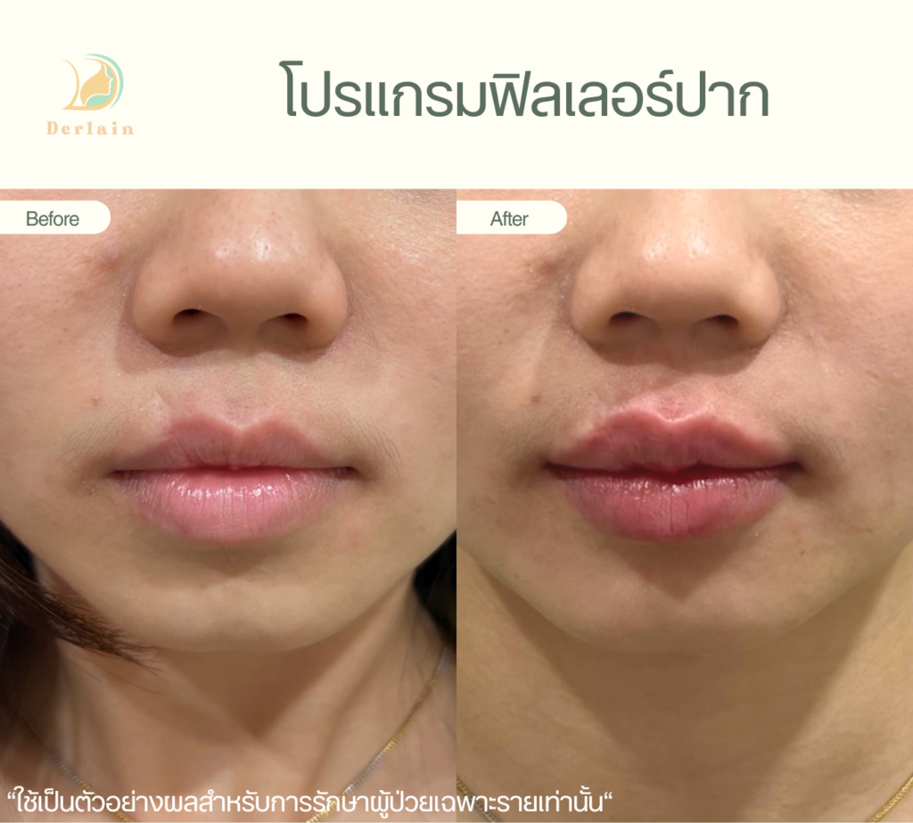 รีวิวฟิลเลอร์ปาก 5 - เดอร์เลนคลินิก
