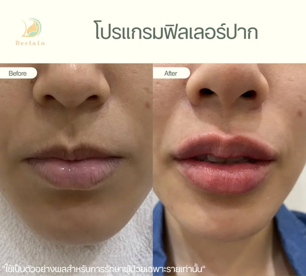 รีวิวฟิลเลอร์ปาก 6 - เดอร์เลนคลินิก
