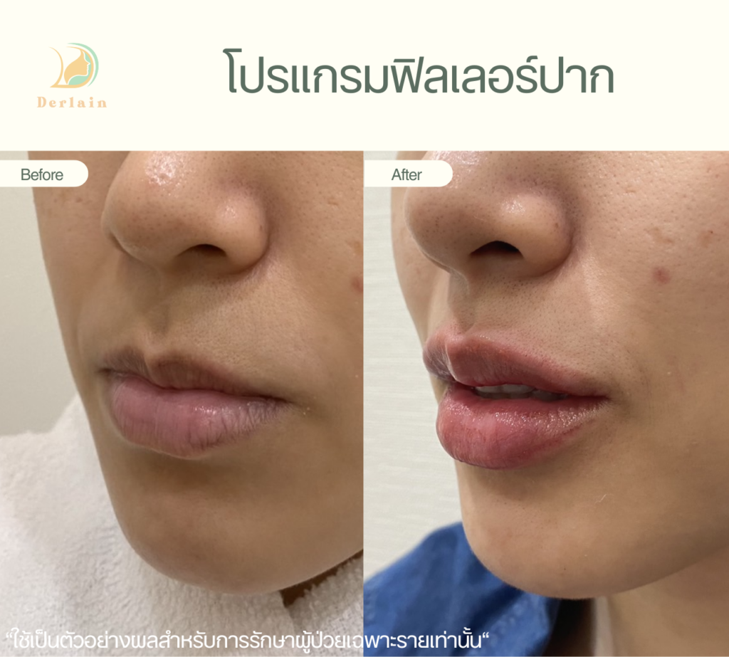 รีวิวฟิลเลอร์ปาก 7 - เดอร์เลนคลินิก