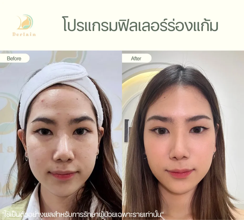 รีวิวฟิลเลอร์ร่องแก้ม 1 - เดอร์เลนคลินิก