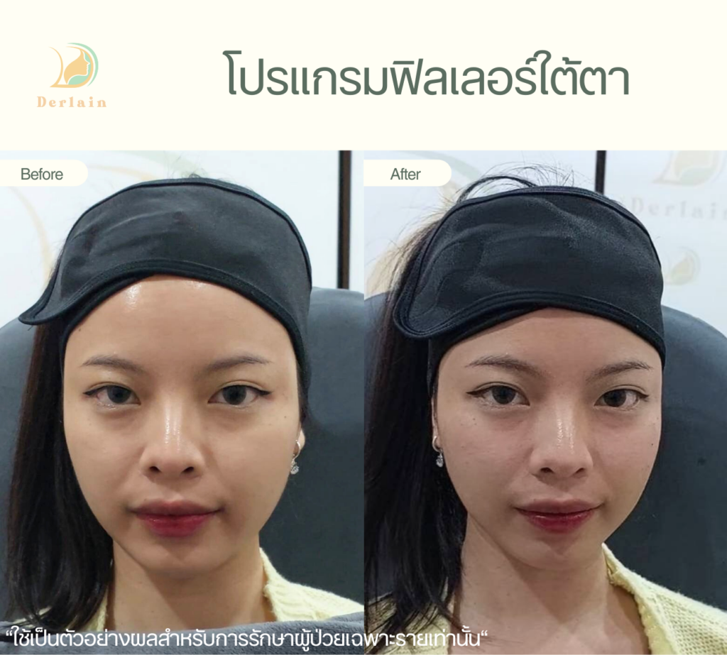 รีวิวฟิลเลอร์ใต้ตา 1 - เดอร์เลนคลินิก
