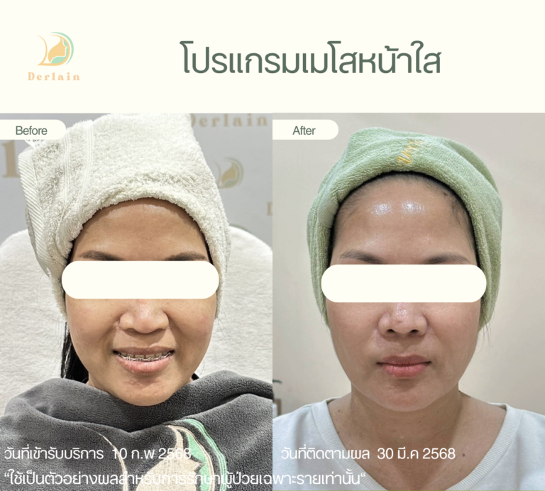 Mesotherapy - Derlain clinic